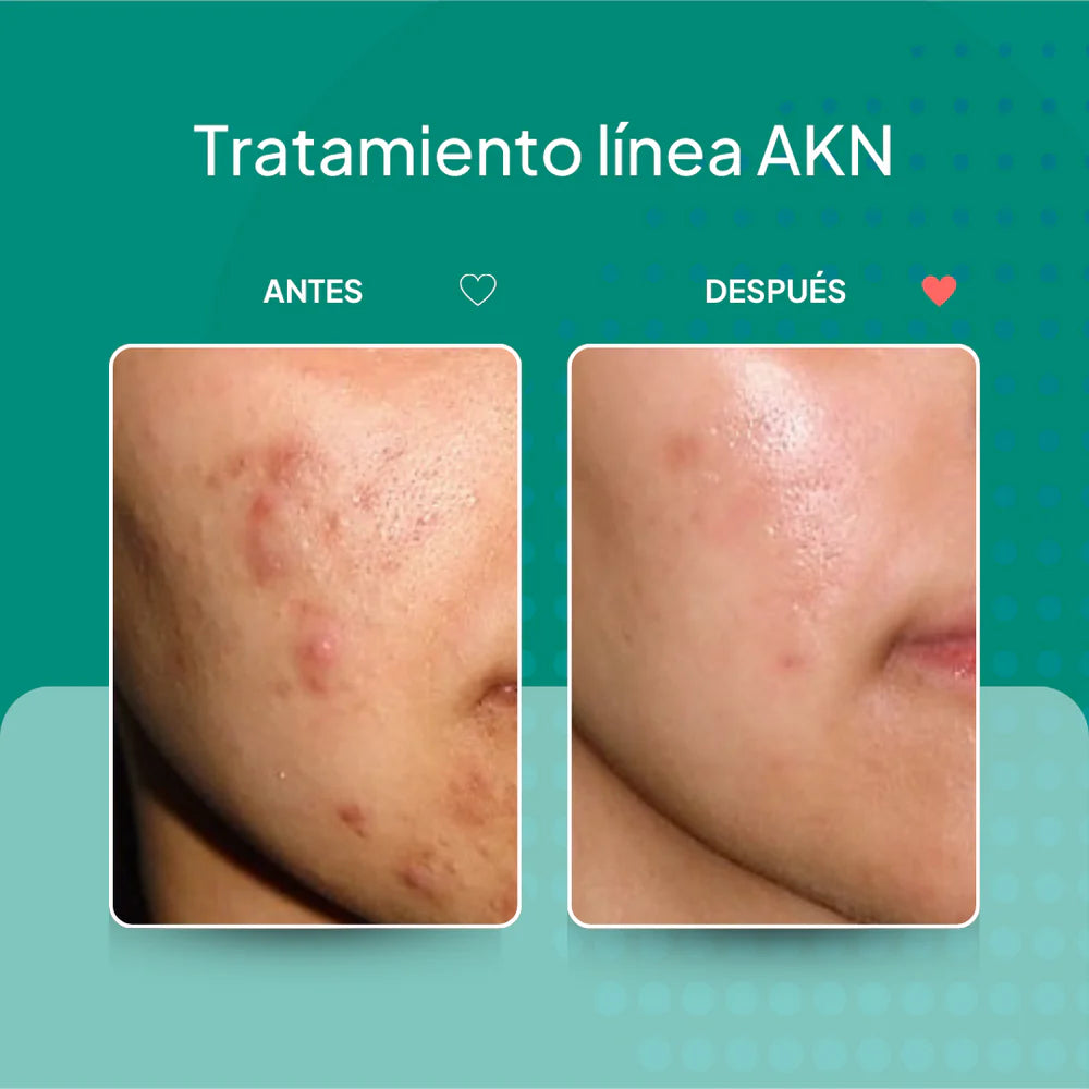 Inno-Derma AKN Day Gel / Hidratante para piel grasa