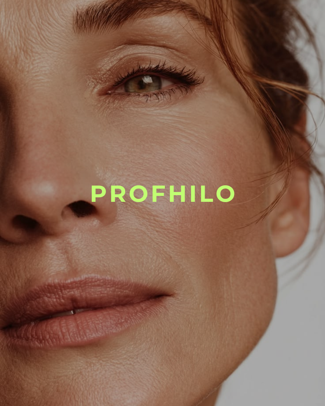 Profhilo: el ácido hialurónico ultrapuro que hidrata, firma y estimula tu colágeno sin dar volumen ni congelar tu expresión (1 sesión)
