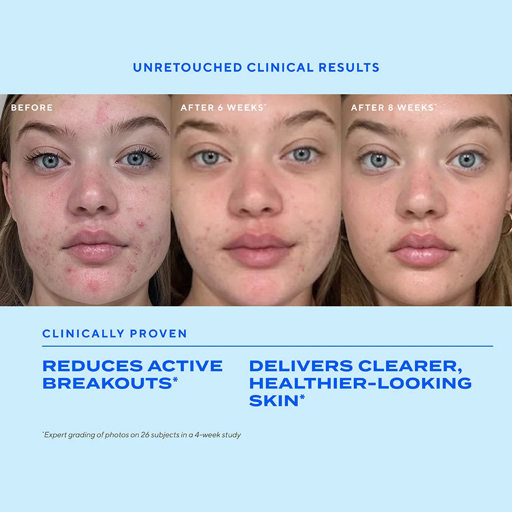 Biome Balancing Clear and Prevent Blemish Treatment Serum | Sérum para Tratamiento del Acné, Equilibra Microbioma y Previene Brotes