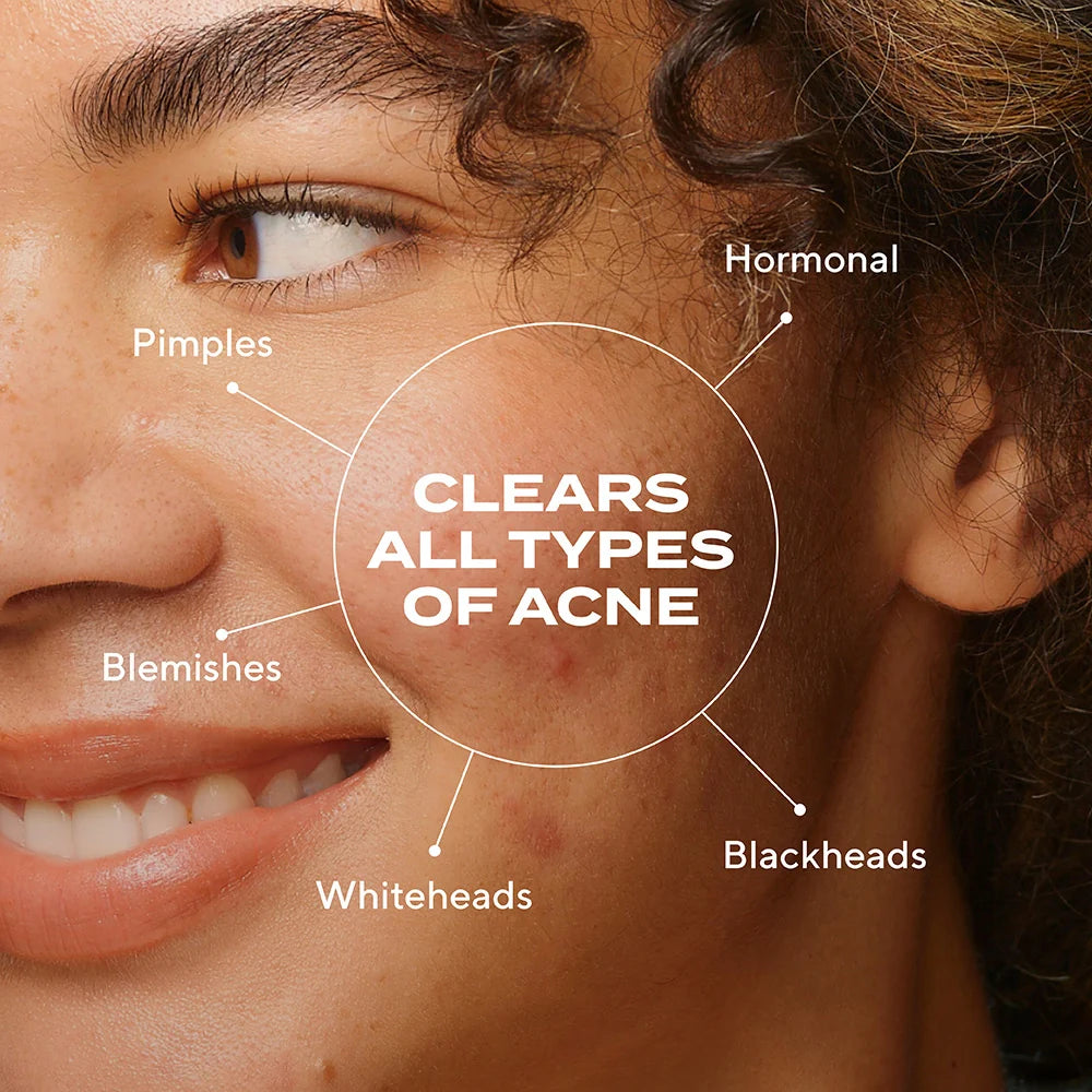 Biome Balancing Clear and Prevent Blemish Treatment Serum | Sérum para Tratamiento del Acné, Equilibra Microbioma y Previene Brotes