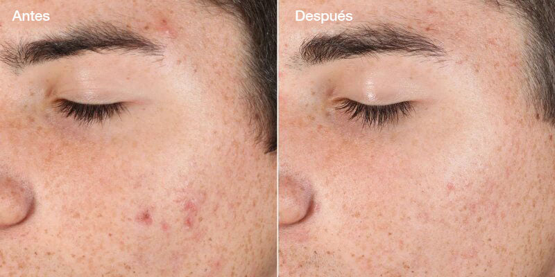 Outsmart Blemish Clarifying Treatment - Serum tratamiento antibrotes y antimanchas