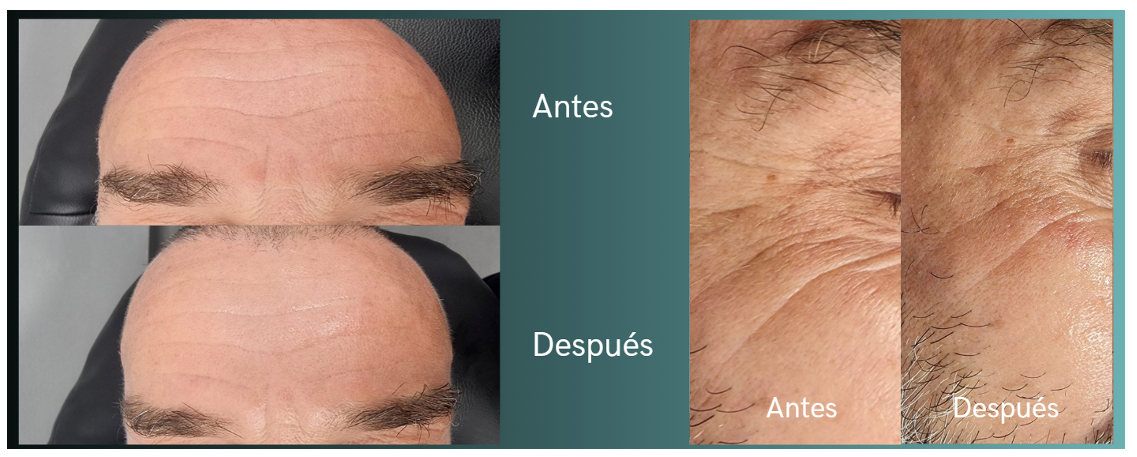 Exocell Mask 1 unidad