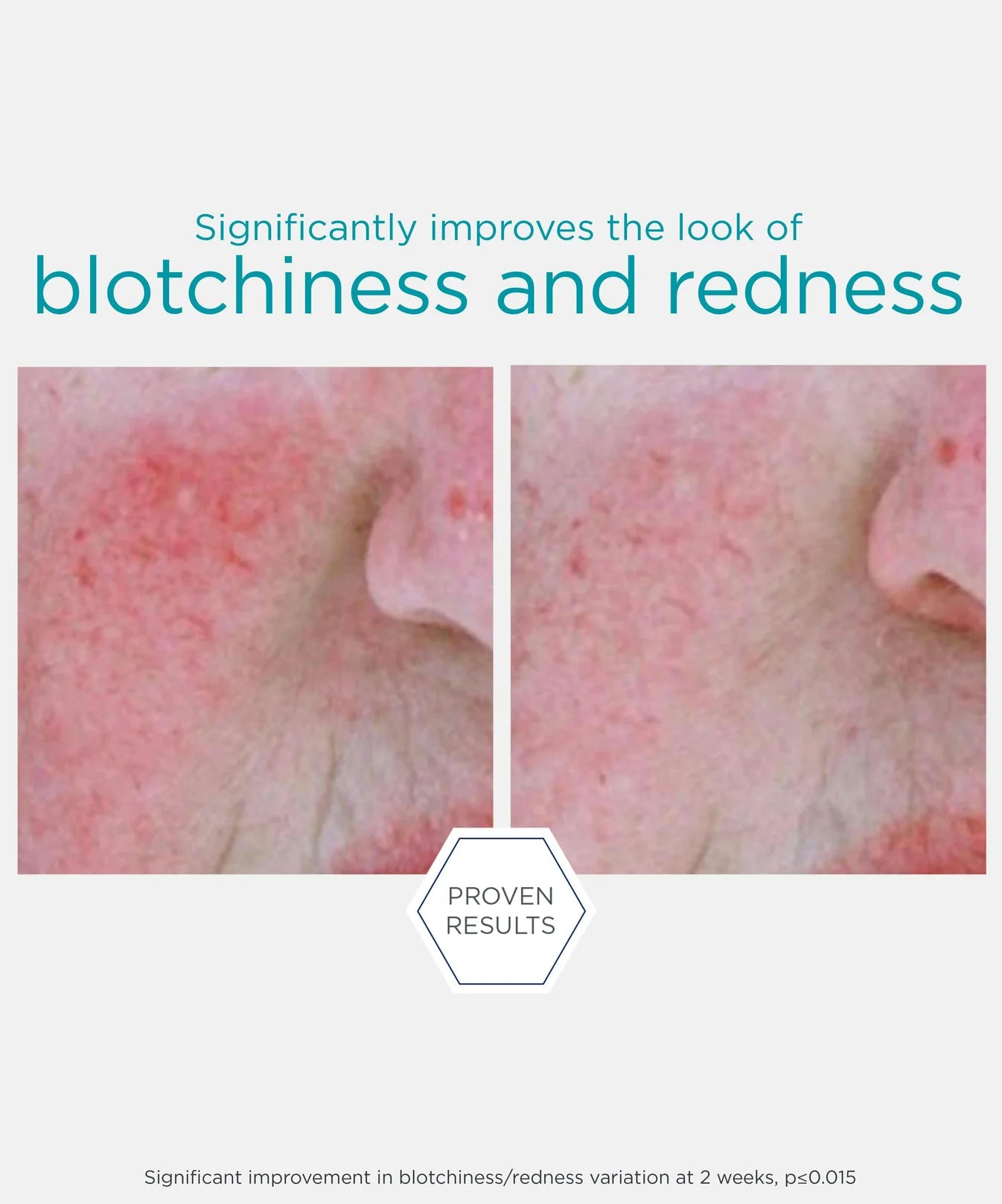 PHA Redness Neutralizing Serum - Serum Neutralizador de rojeces