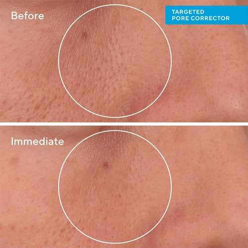Targeted Pore Corrector - Corrector de Poros