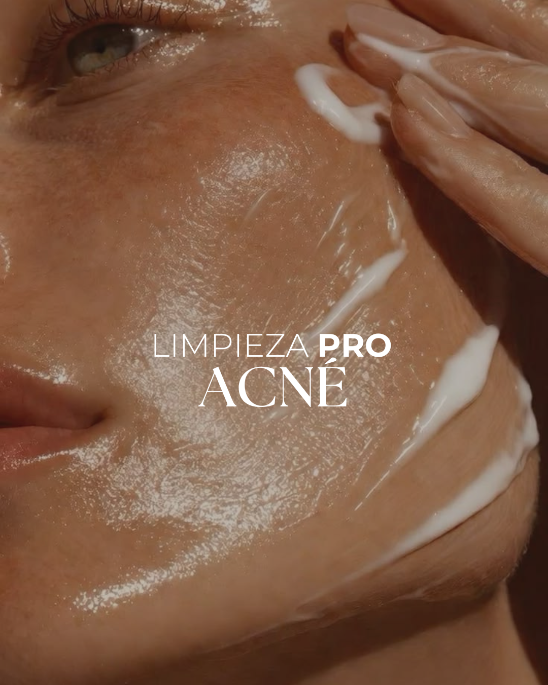LIMPIEZA PIELES ACNEICAS · Protocolo profesional con peeling y extracción para tratar el acné, imperfecciones y poros congestionados