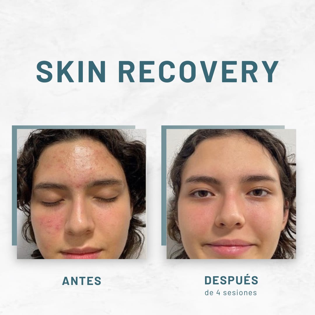 Peeling Facial Personalizado para Manchas, Rojeces o Acné + Crema Restore de Regalo: el profesional elige el ideal para ti y tu piel se recupera en casa con la crema incluida
