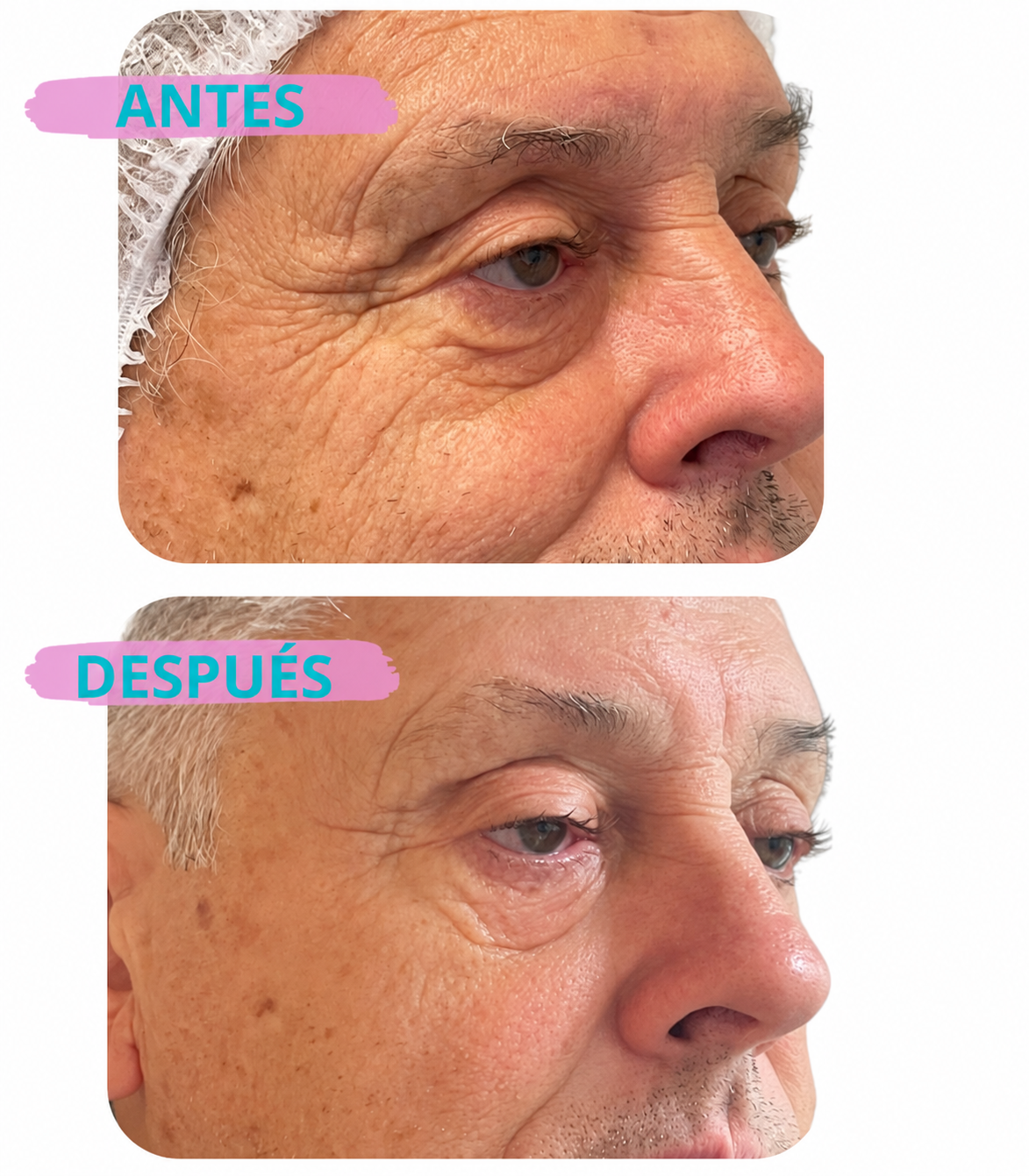 BCN Oculare Peptides: el cóctel inyectable de péptidos que trata bolsas, ojeras y patas de gallo en una sola zona — tu contorno de ojos transformado