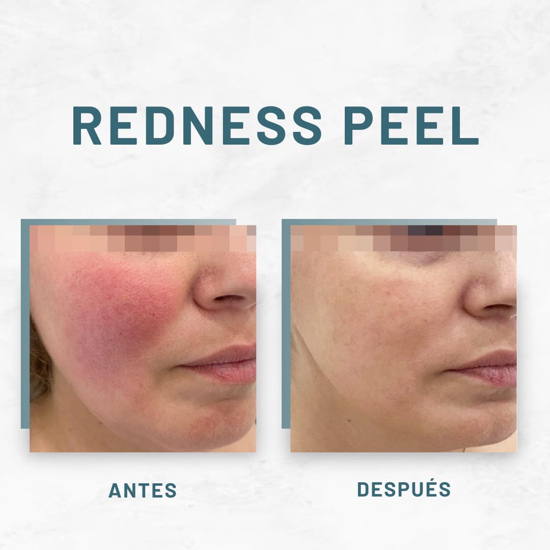 Peeling Facial Personalizado para Manchas, Rojeces o Acné + Crema Restore de Regalo: el profesional elige el ideal para ti y tu piel se recupera en casa con la crema incluida