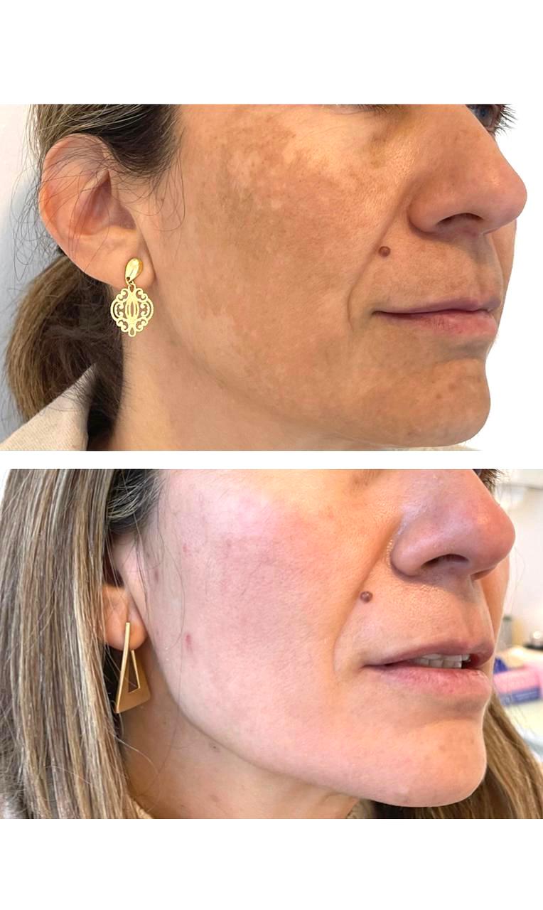 Dermamelan Tratamiento Producto - Despigmentante Potente