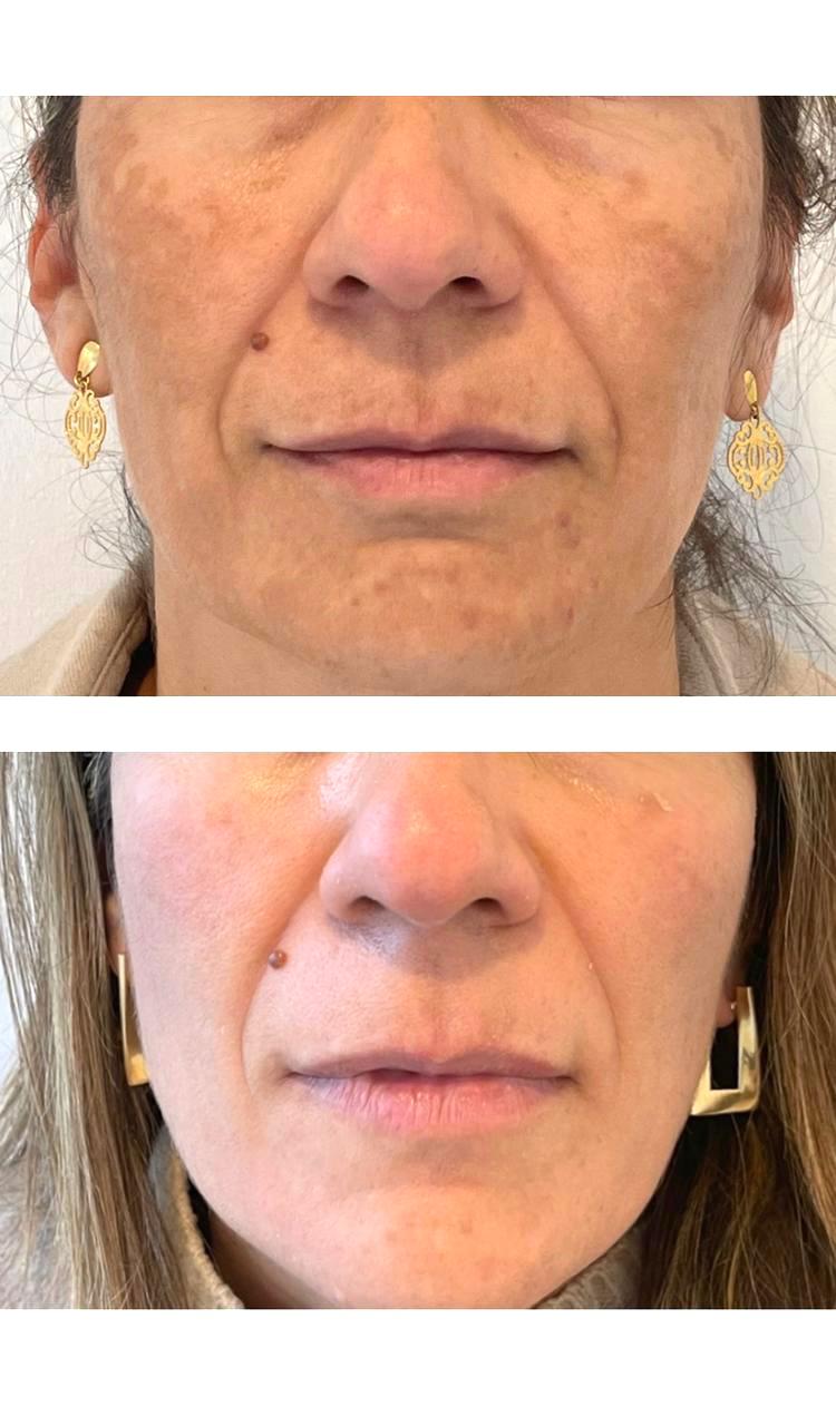 Dermamelan Tratamiento Producto - Despigmentante Potente