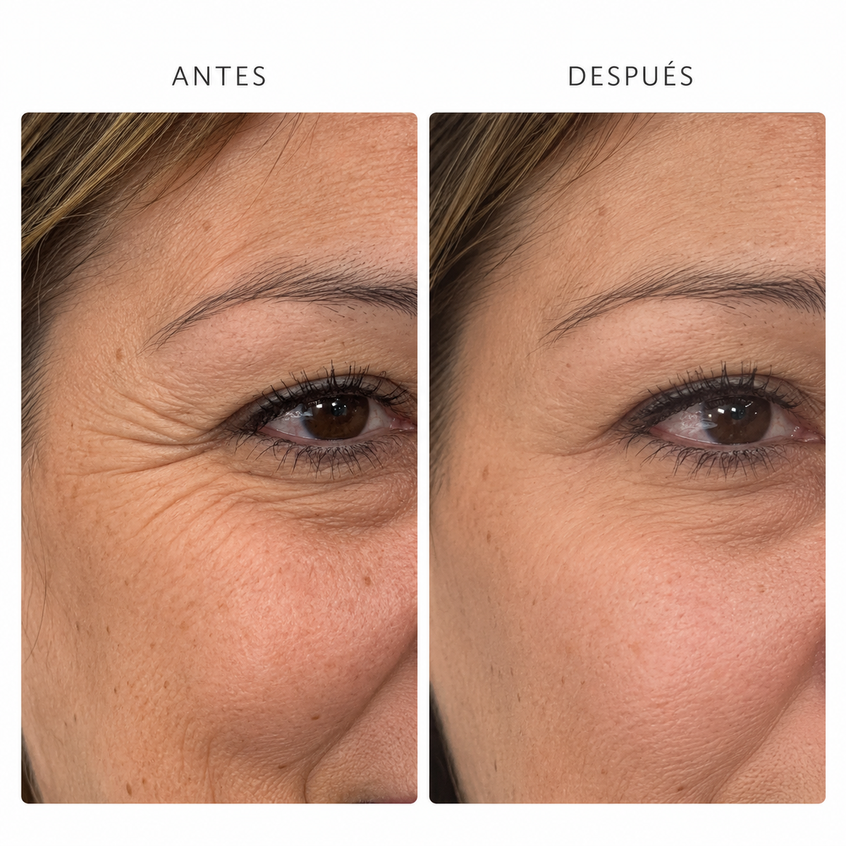 Viscoderm Hydrobooster para Patas de Gallo: suaviza las líneas del contorno de ojos sin botox, sin paralizar tu expresión y con resultados completamente naturales