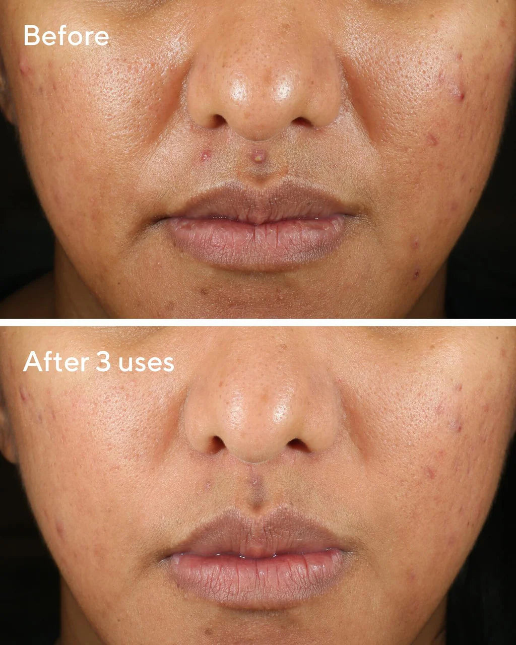 Rapid Relief Acne Sulfur Mask -  Máscara triple acción para reducir la oleosidad, reduce brotes en sólo 3 aplicaciones