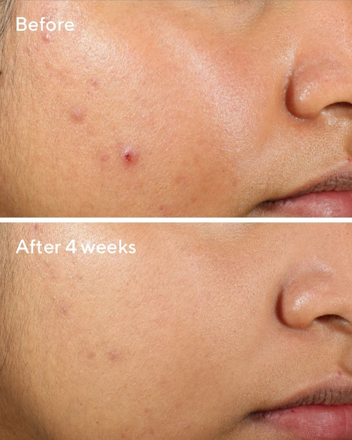 Clarifying Oil Free Water Gel - Gel Hidratante Gel Hidratante Facial con Ácido Hialurónico y Ácido Salicílico