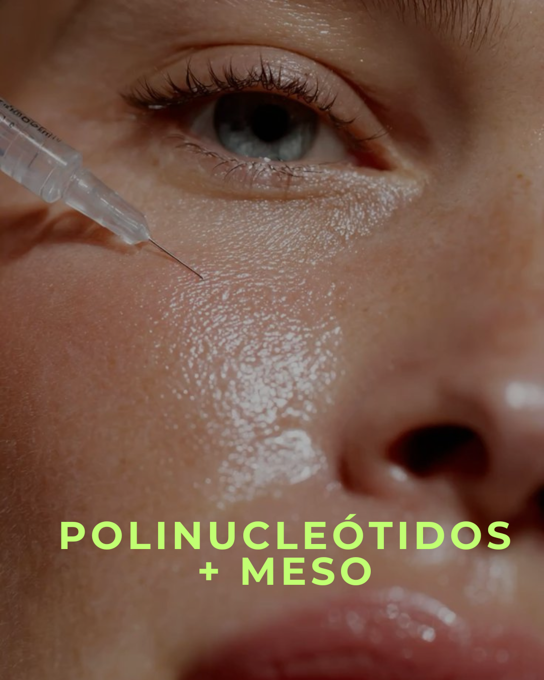 Polinucleótidos de ADN de Salmón (Plenhyage) + Mesoterapia Restructurer de Regalo: regeneración celular profunda y protección antioxidante en una sola sesión