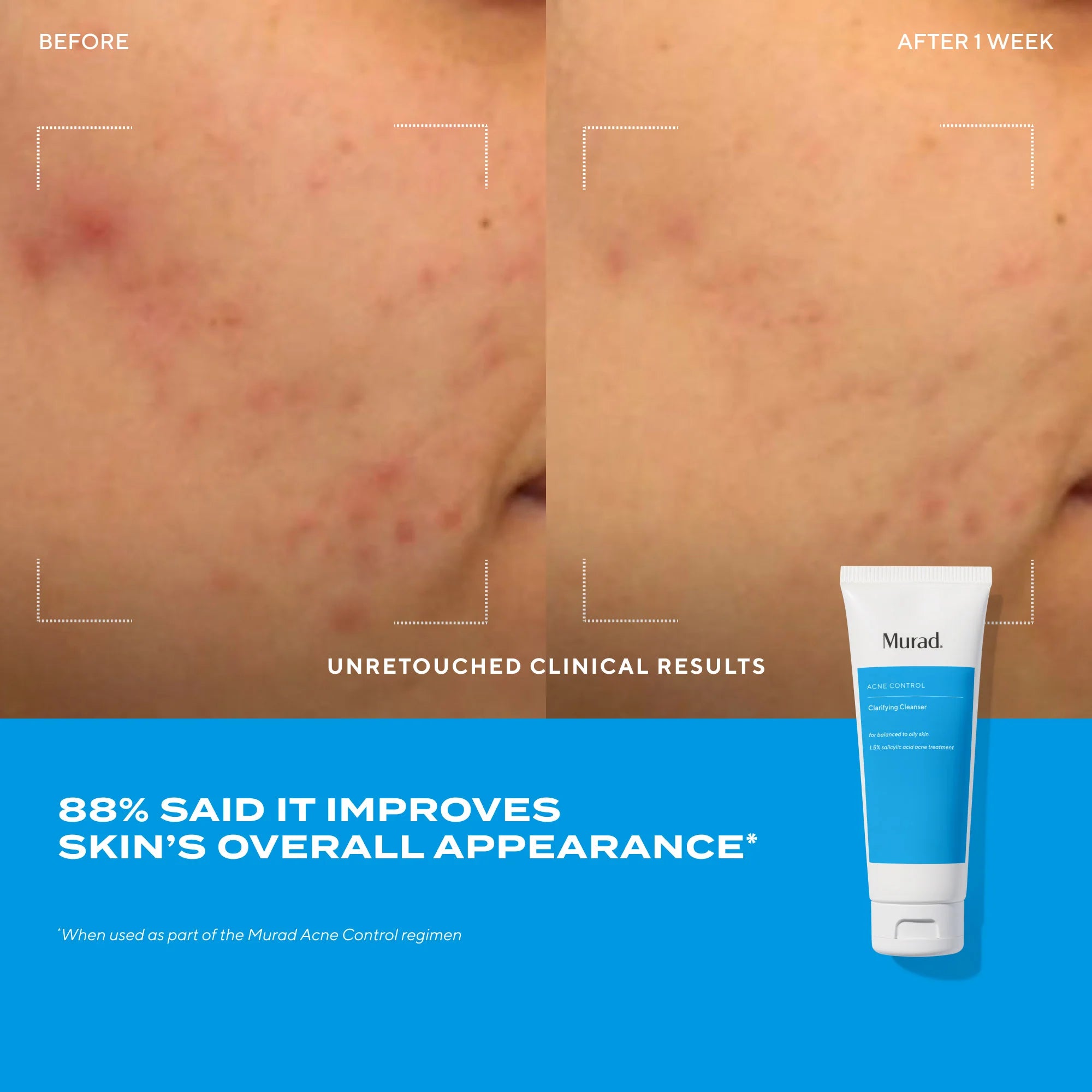 Clarifying Cleanser - Gel Limpiador para Piel Grasa, Control de Acné e Imperfecciones