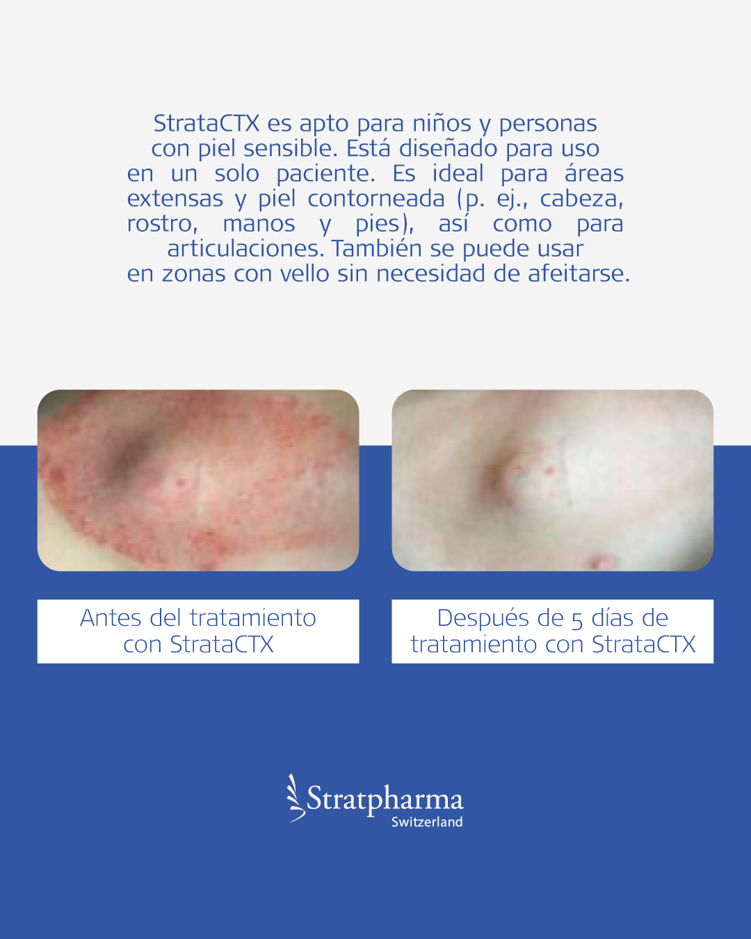 StrataCTX - Gel no esteroidal para piel seca y reacciones cutáneas