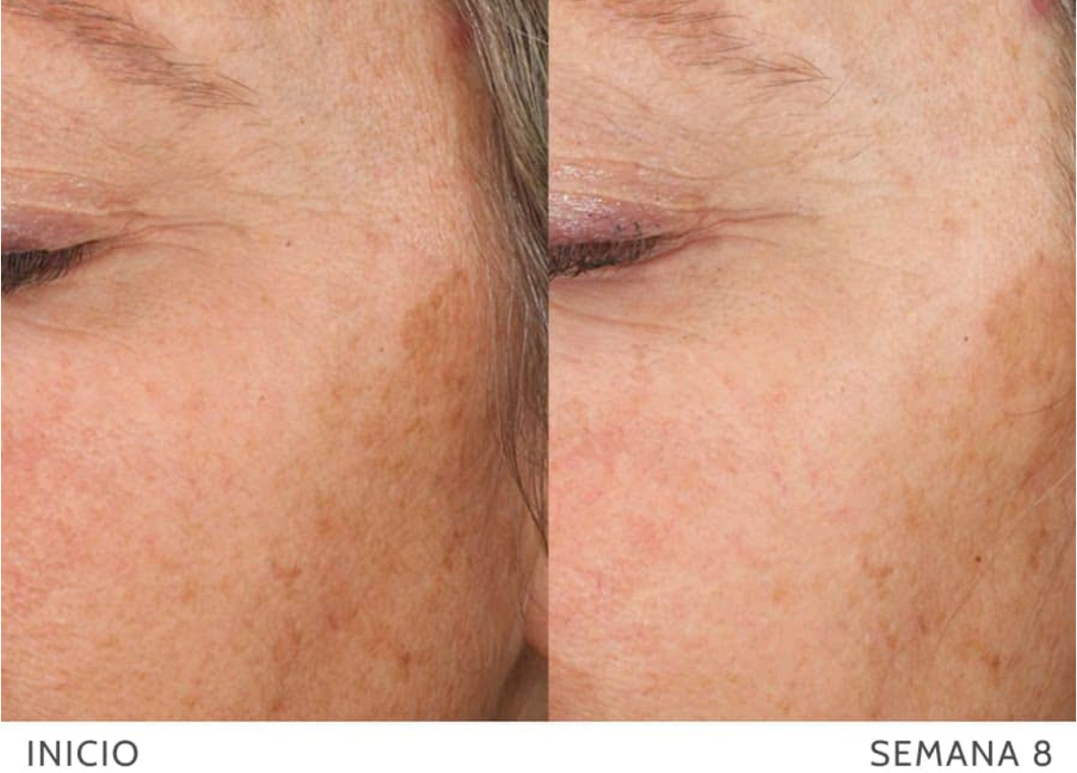 Pigment Lightening Gel - Gel despigmentante para manchas localizadas