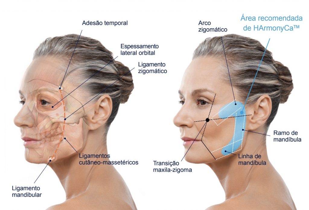 Harmonyca Day JUNTO A LABORATORIO ALLERGAN - Tratamiento ★ más potente para efecto lifting CON Descuento exclusivo POR ÚNICA VEZ ¡solo 10 cupos!