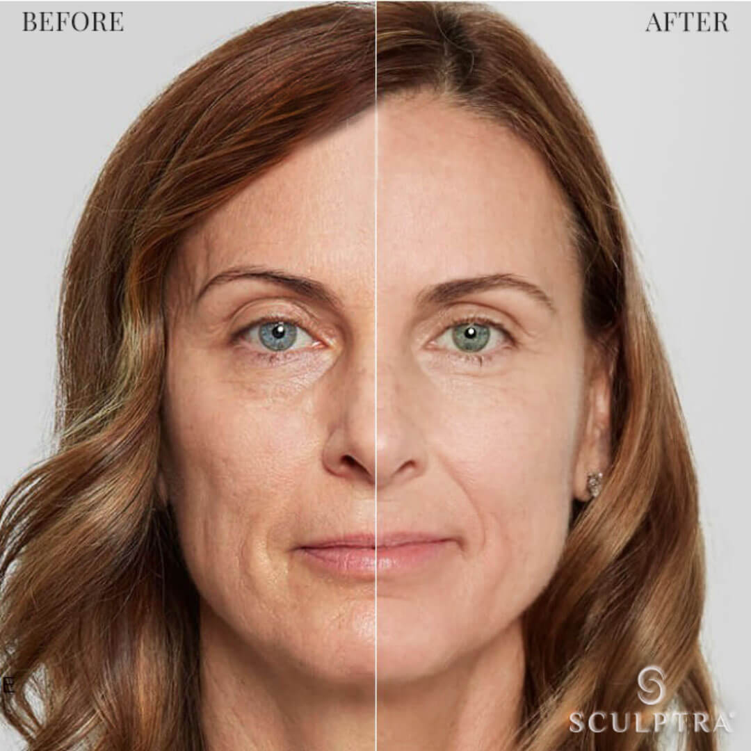 Sculptra: Bioestimulador progresivo y natural que estimula colágeno y redensifica la piel.