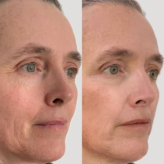 Profhilo Experience: el ácido hialurónico no reticulado ultrapuro que hidrata, reafirma y estimula colágeno sin dar volumen — con sorpresas para quienes compren y vengan esta primera semana de septiembre