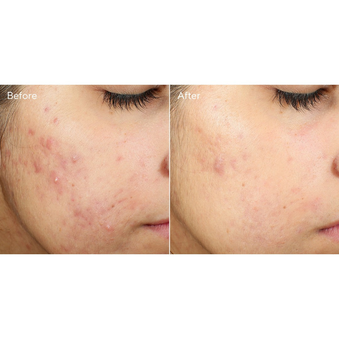 InvisiScar Resurfacing Treatment / Tratamiento cicatrices de acné