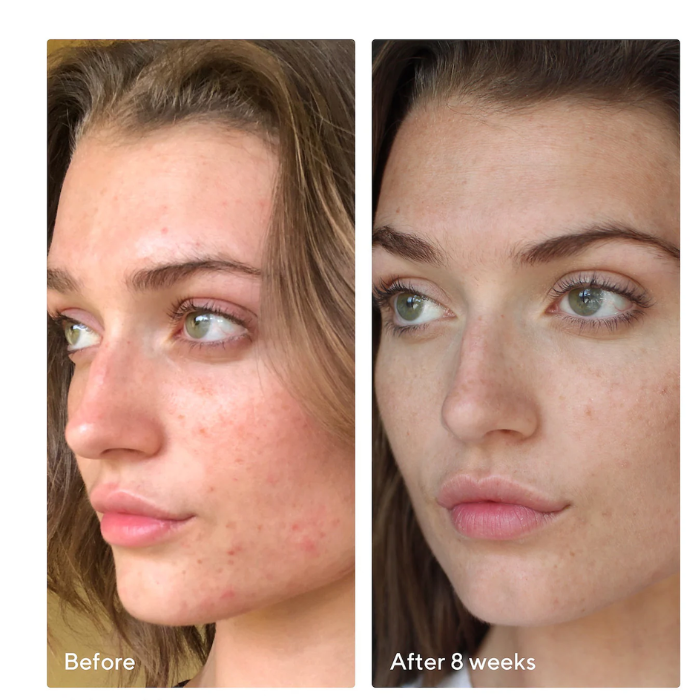 InvisiScar Resurfacing Treatment / Tratamiento cicatrices de acné