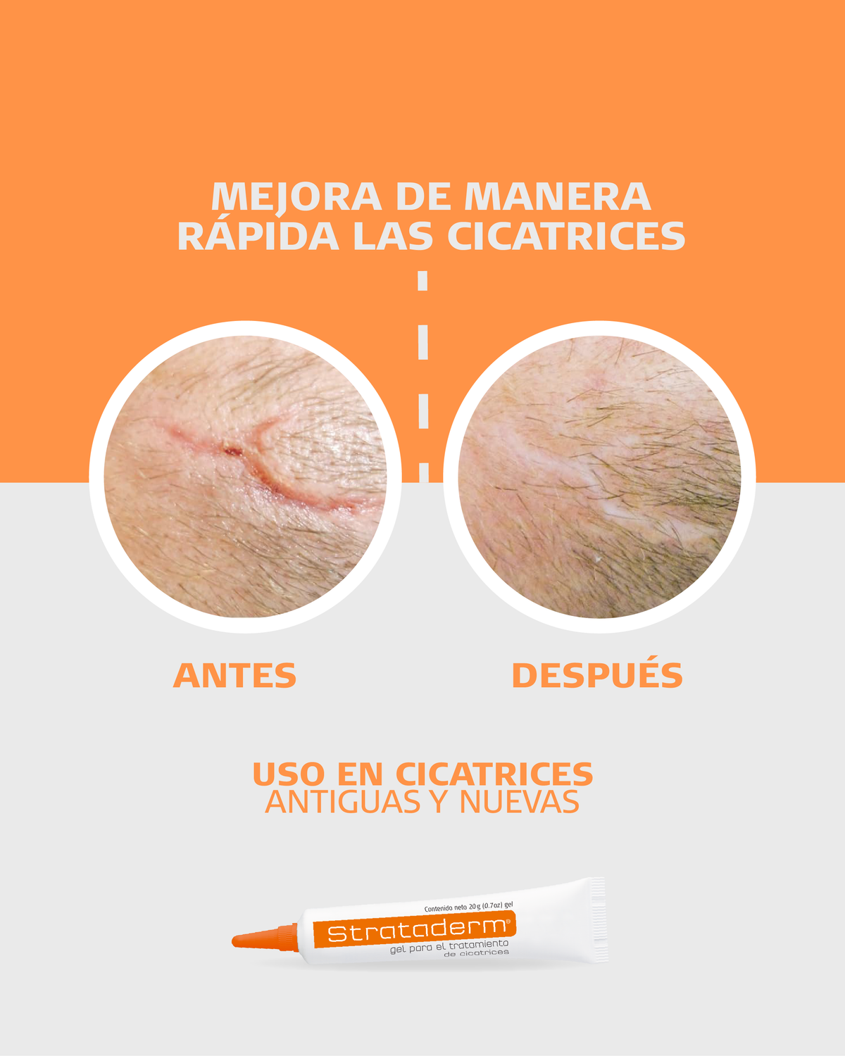 Strataderm - Gel de Silicona para Tratar Cicatrices Nuevas y Antiguas | Heridas ya cicatrizadas