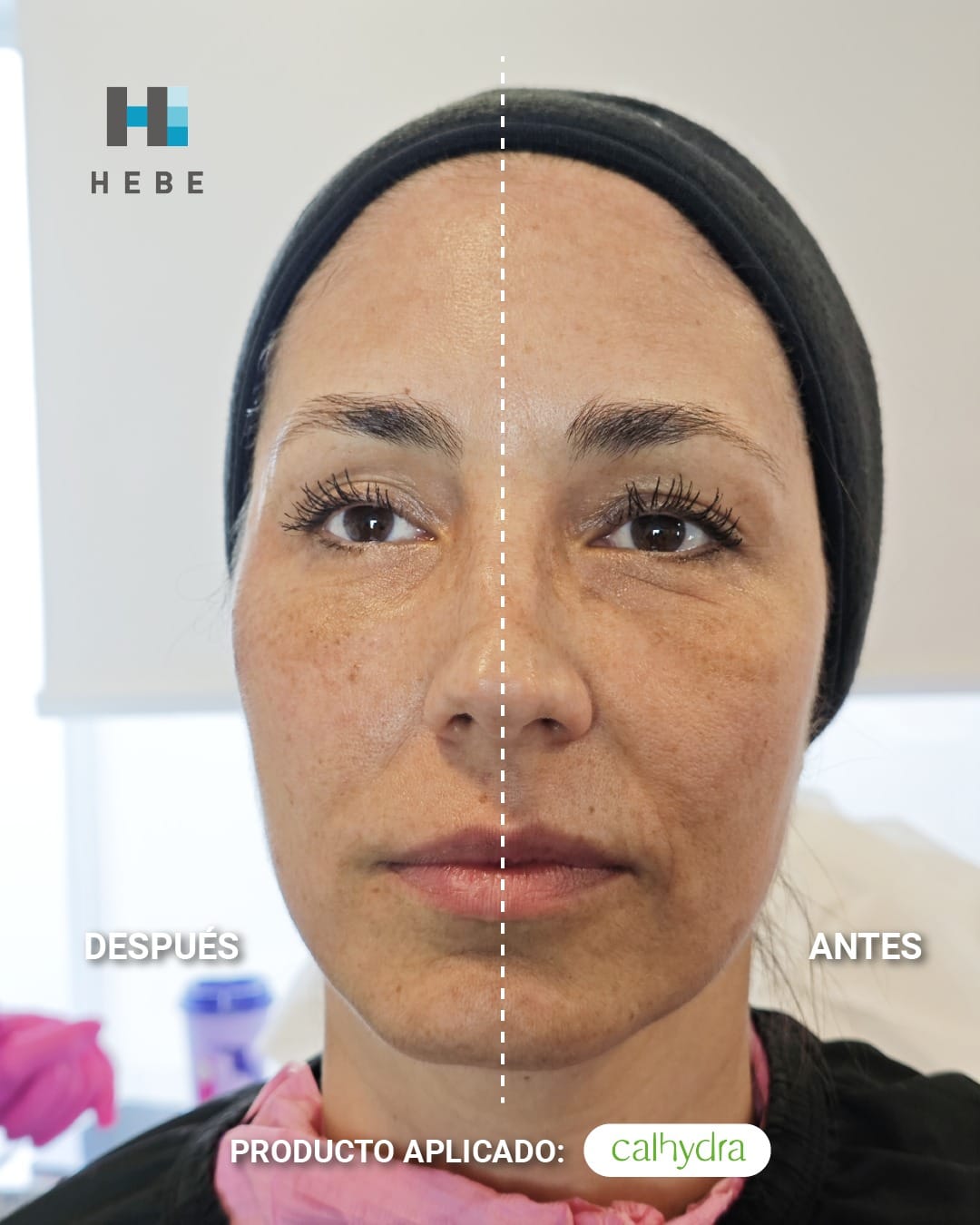 Calhydra: el bioestimulador híbrido que estimula tu colágeno e hidrata tu piel con efecto lifting natural desde la primera sesión