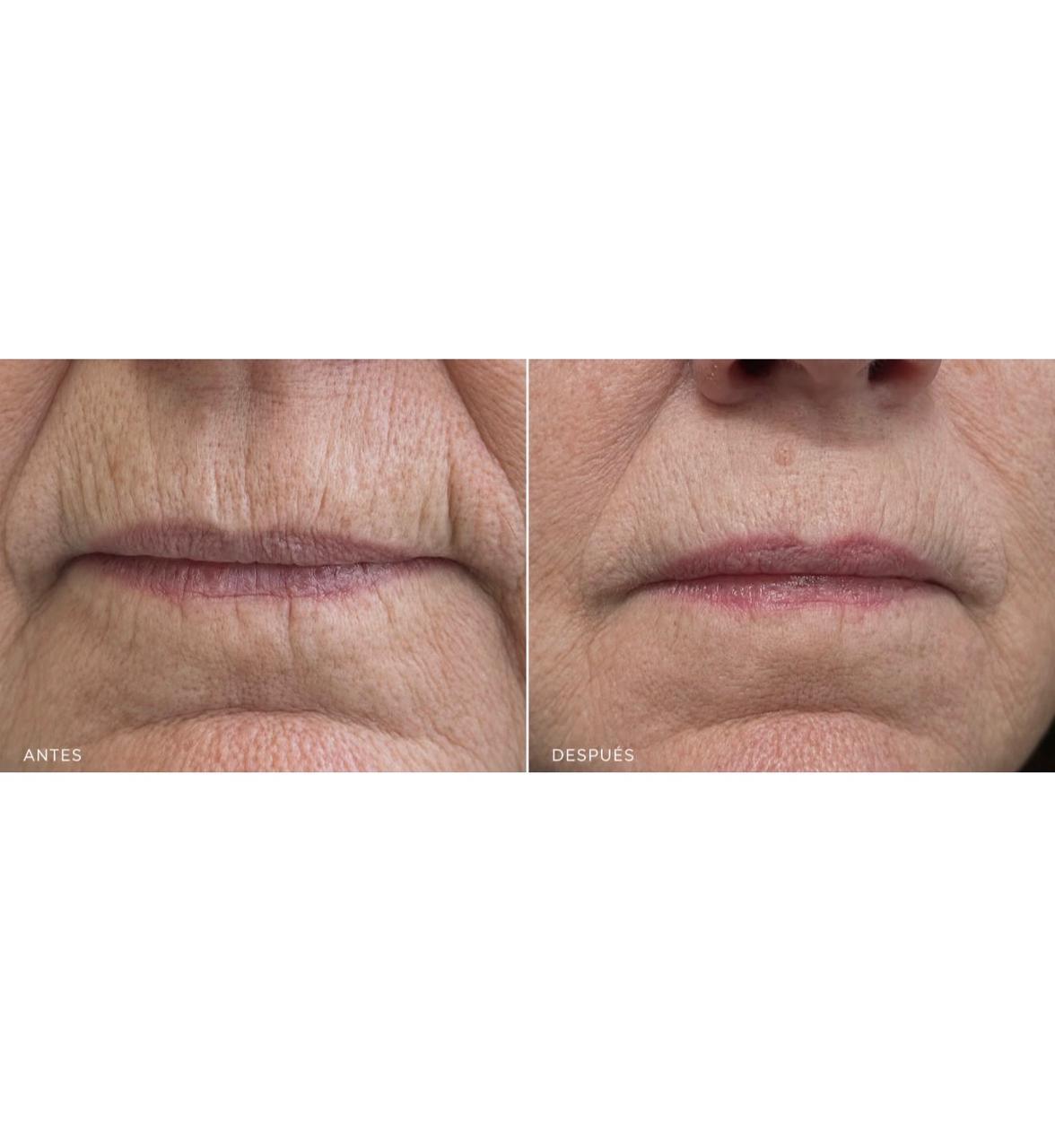 Código de Barras con Ácido Hialurónico Opera Soft: borra esas líneas sobre el labio que ninguna crema puede eliminar, sin congelar tu expresión