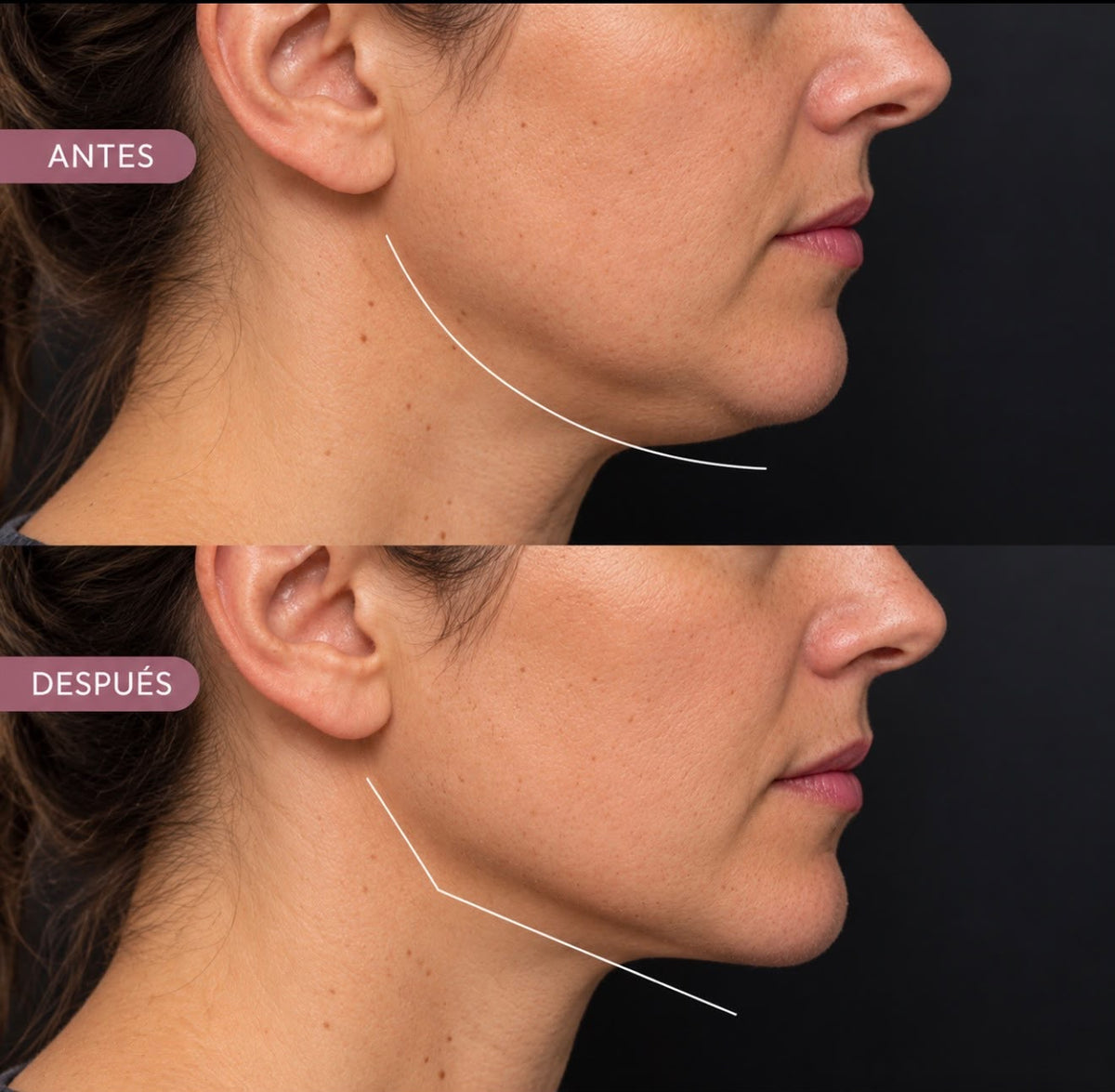 Volux Mentón y Contorno Mandibular: define, proyecta y estructura tu rostro con el relleno más potente del mercado, sin cirugía