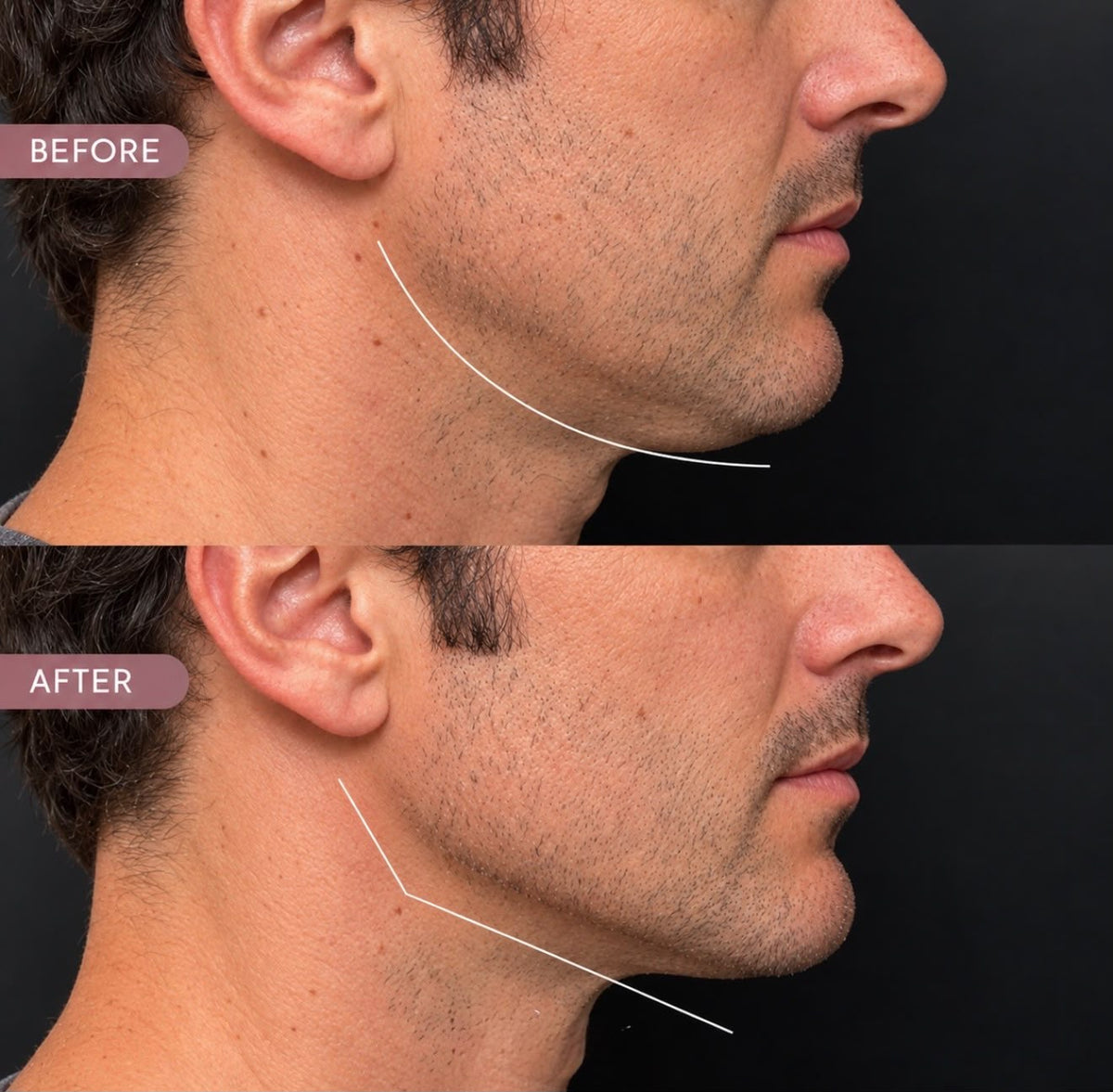 Volux Mentón y Contorno Mandibular: define, proyecta y estructura tu rostro con el relleno más potente del mercado, sin cirugía