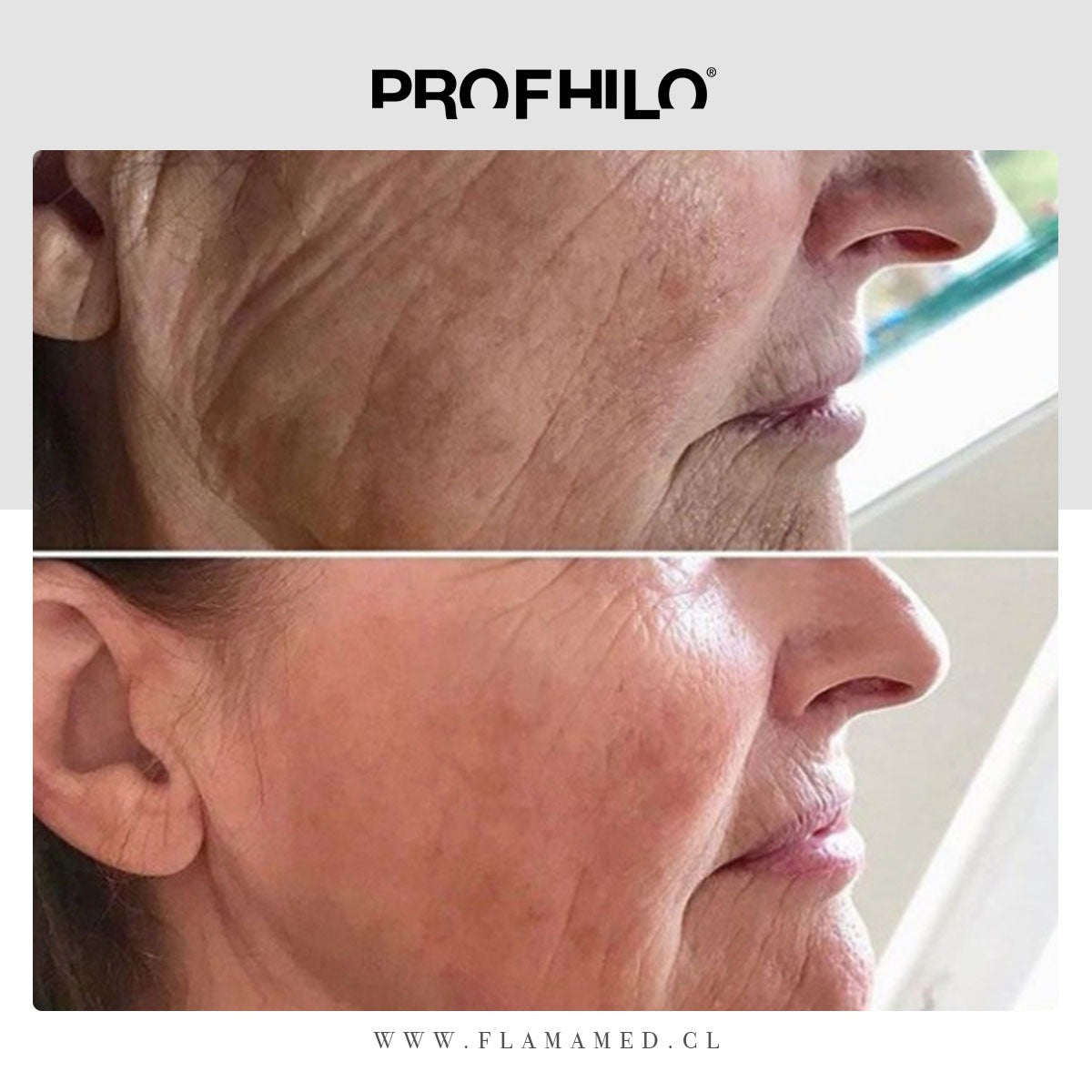 Profhilo Experience: el ácido hialurónico no reticulado ultrapuro que hidrata, reafirma y estimula colágeno sin dar volumen — con sorpresas para quienes compren y vengan esta primera semana de septiembre
