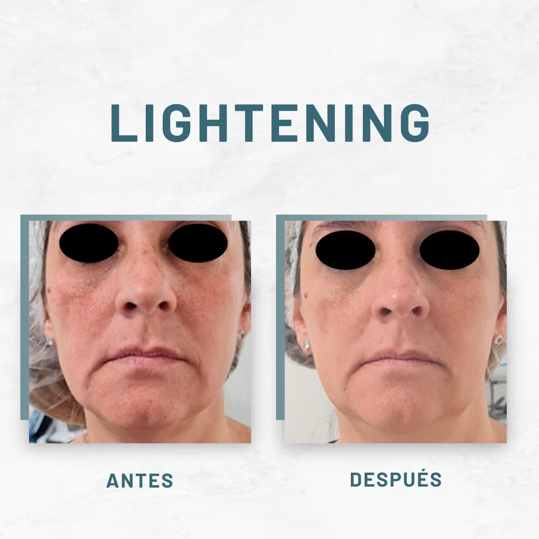 Peeling Facial Personalizado para Manchas, Rojeces o Acné + Crema Restore de Regalo: el profesional elige el ideal para ti y tu piel se recupera en casa con la crema incluida