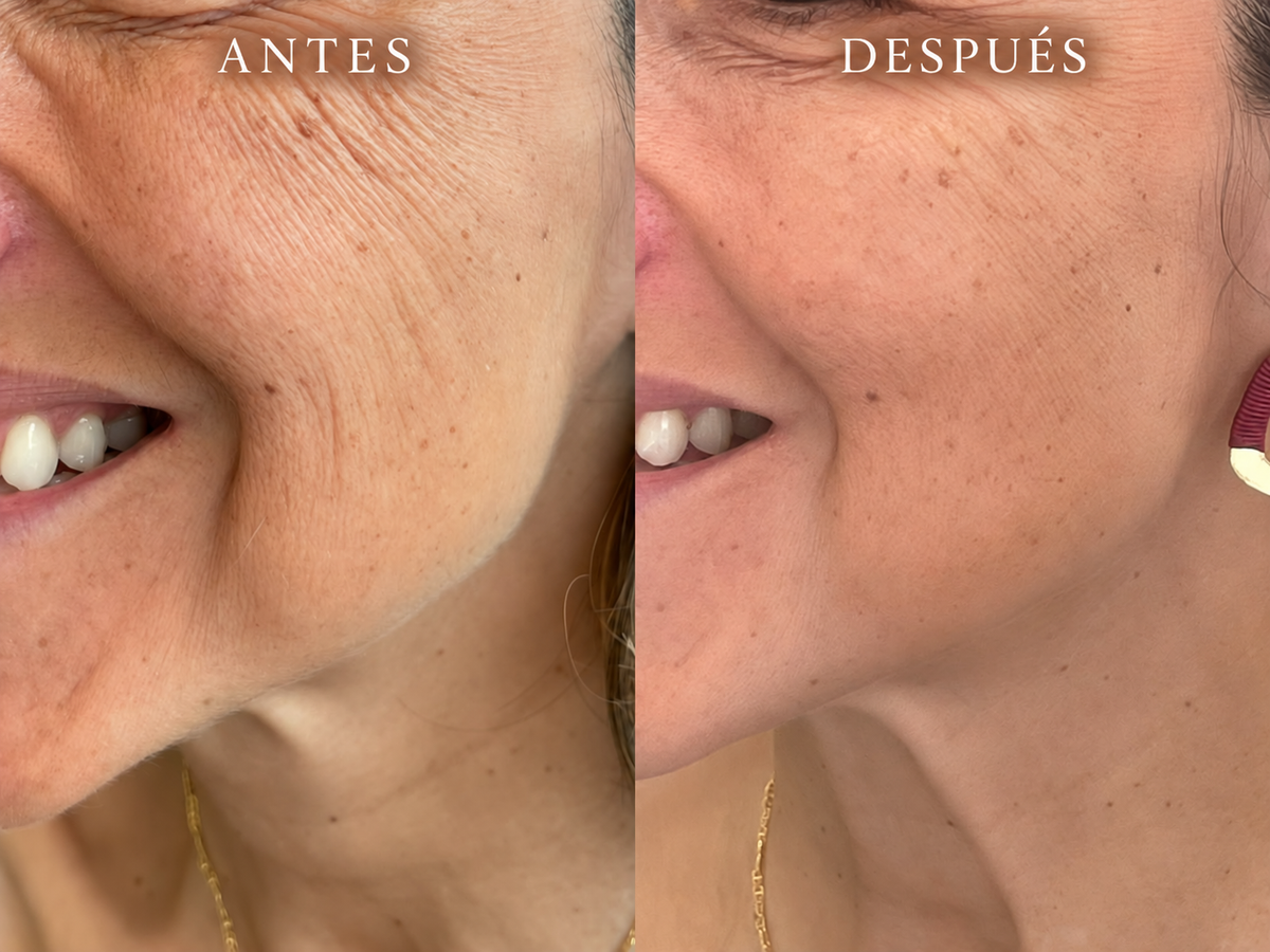 Elástica Dorada: el inyectable suizo con péptidos biomiméticos y aminoácidos que regenera, hidrata y rejuvenece tu piel sin rellenar ni cambiar tus facciones