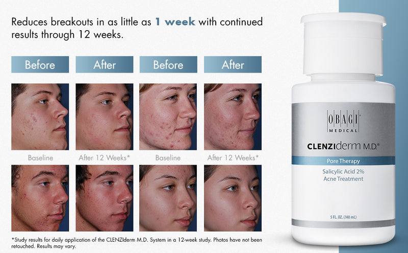 CLENZIderm M.D.® Pore Therapy / Terapia de Poros