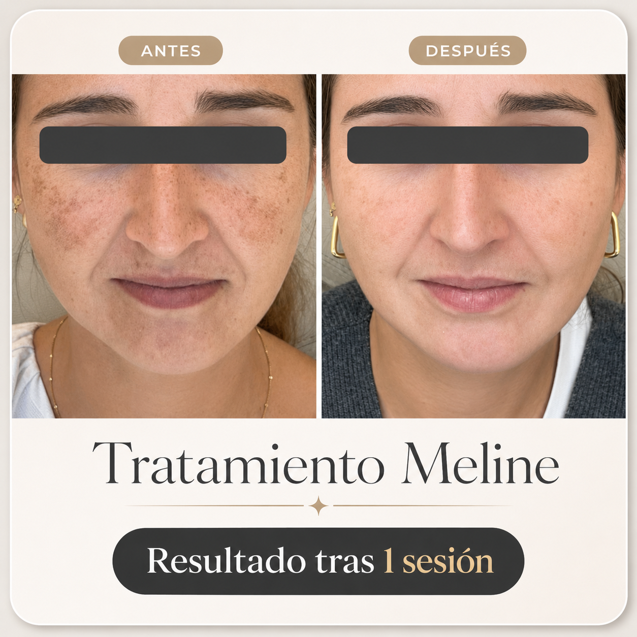 Peeling Meline: el tratamiento especializado que borra manchas, melasma y pigmentación irregular para una piel más uniforme y luminosa (1 sesión)