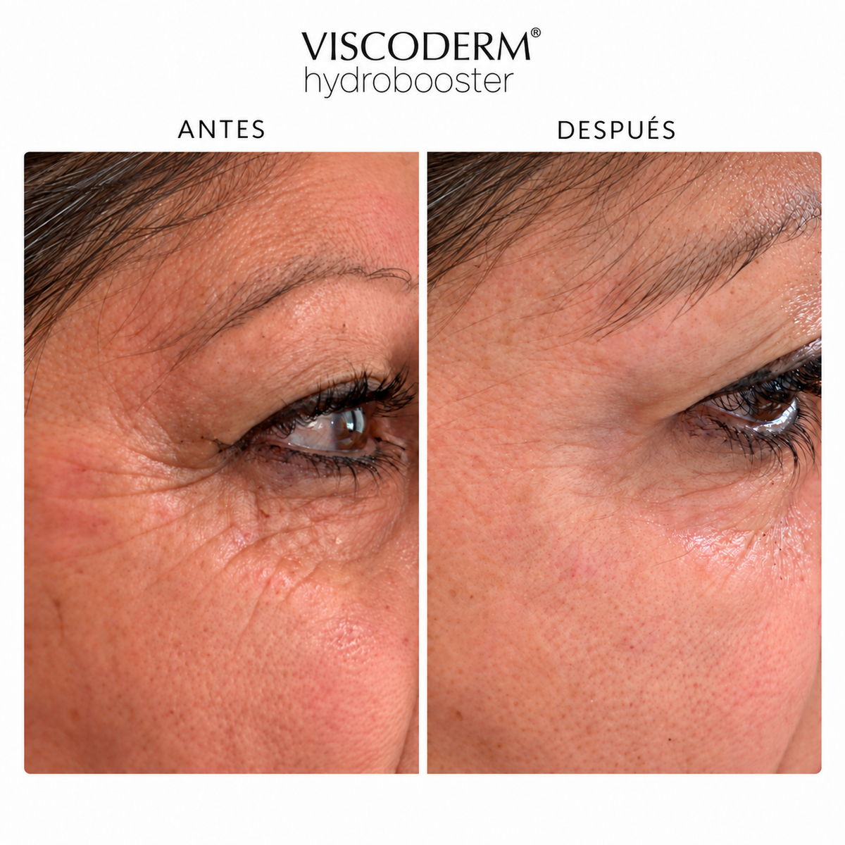 Viscoderm Hydrobooster para Patas de Gallo: suaviza las líneas del contorno de ojos sin botox, sin paralizar tu expresión y con resultados completamente naturales
