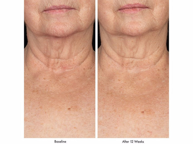 ELASTIderm® Neck and Décolleté Concentrate